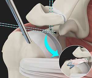 Arthroscopic Superior Capsular Reconstruction (SCR)