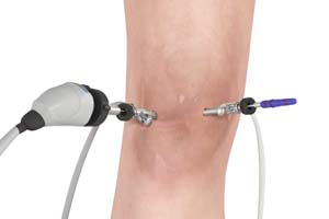 arthroscopic-reconstruction-of-the-knee-for-ligament-injuries