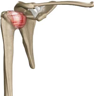 Rotator Cuff Tear