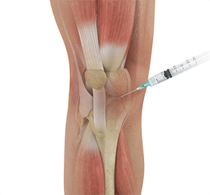Intraarticular Knee Injection