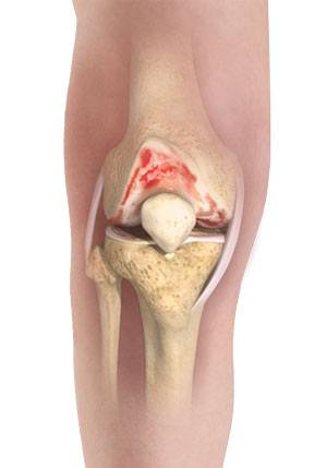 knee-osteoarthritis