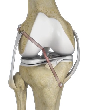 Ligament Reconstruction