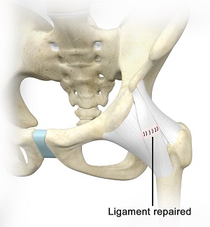 Ligament Preservation/Repair