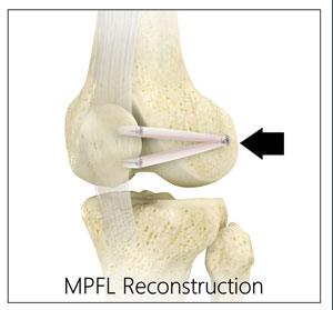 Medial Patellofemoral Ligament (MPFL) Tears