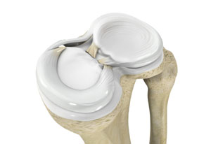 meniscal-injuries