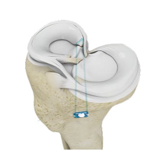 Meniscus Root Repair