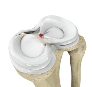 Meniscus Root Tear