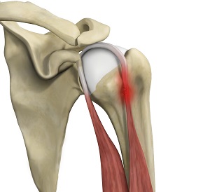 Proximal Biceps Tendinitis