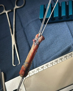 ACL Reconstruction