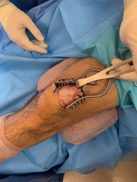 Quadriceps tendon repair with patch augmentation