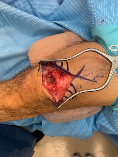 Quadriceps tendon repair with patch augmentation