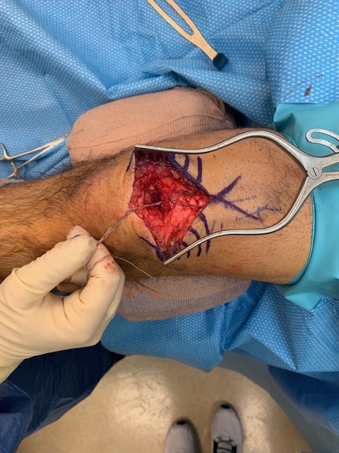 Quadriceps tendon repair with patch augmentation