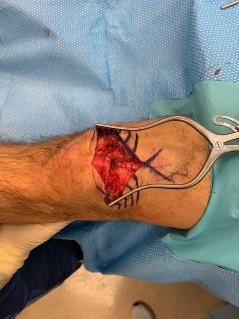 Quadriceps tendon repair with patch augmentation