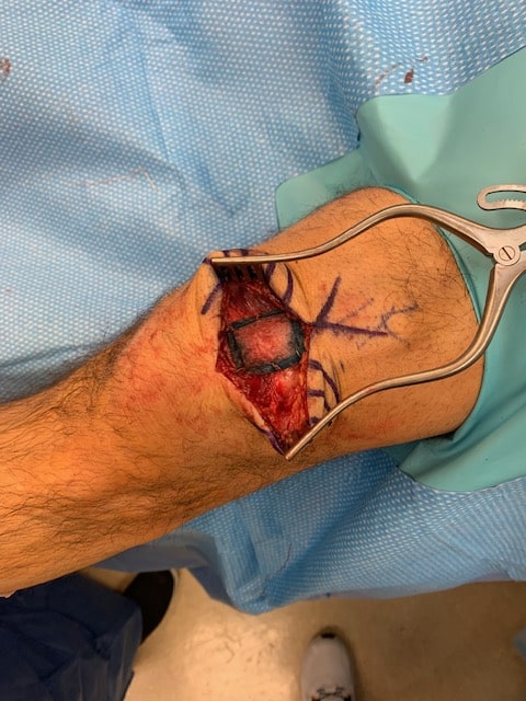 Quadriceps tendon repair with patch augmentation