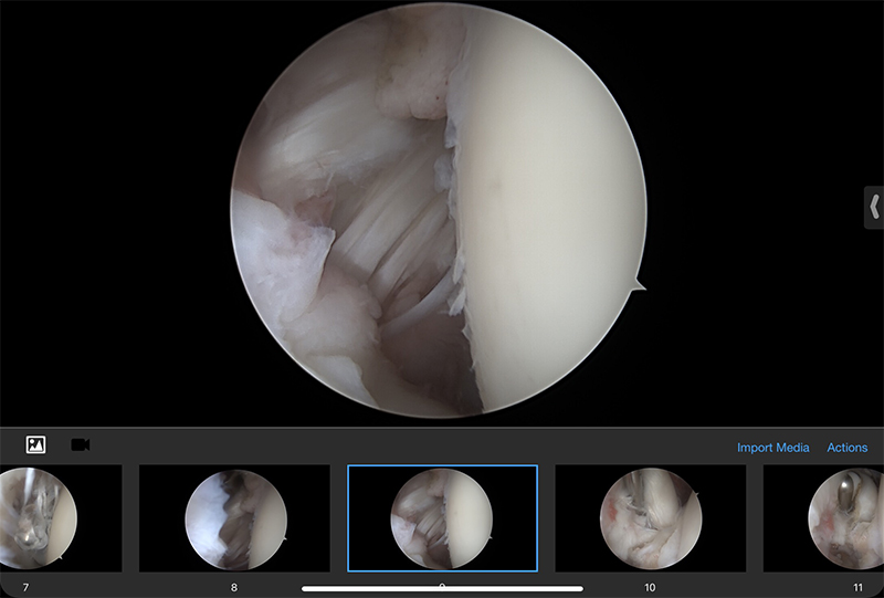 Rotator Cuff Repair