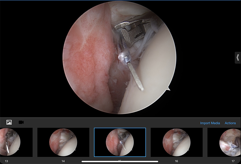 Rotator Cuff Repair