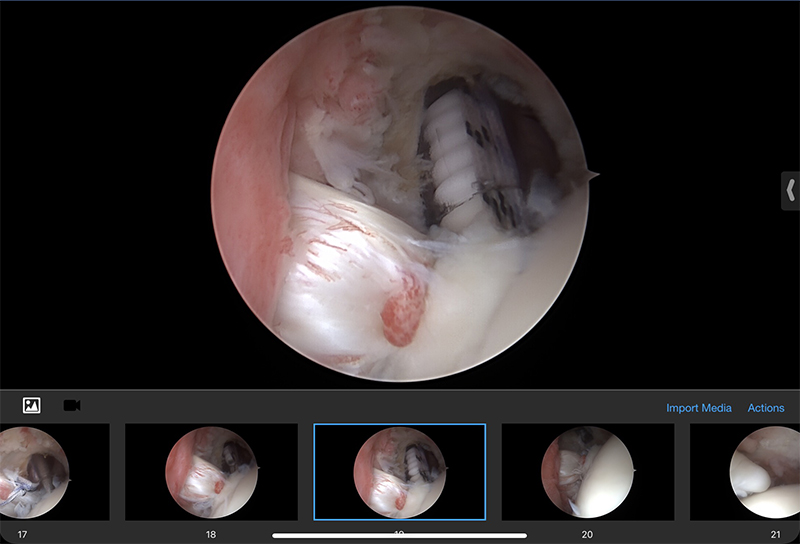 Rotator Cuff Repair