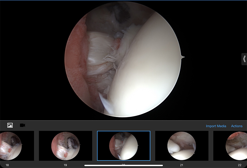 Rotator Cuff Repair