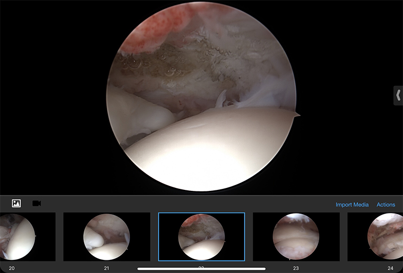 Rotator Cuff Repair