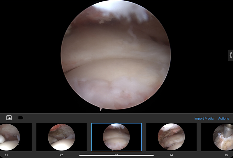 Rotator Cuff Repair