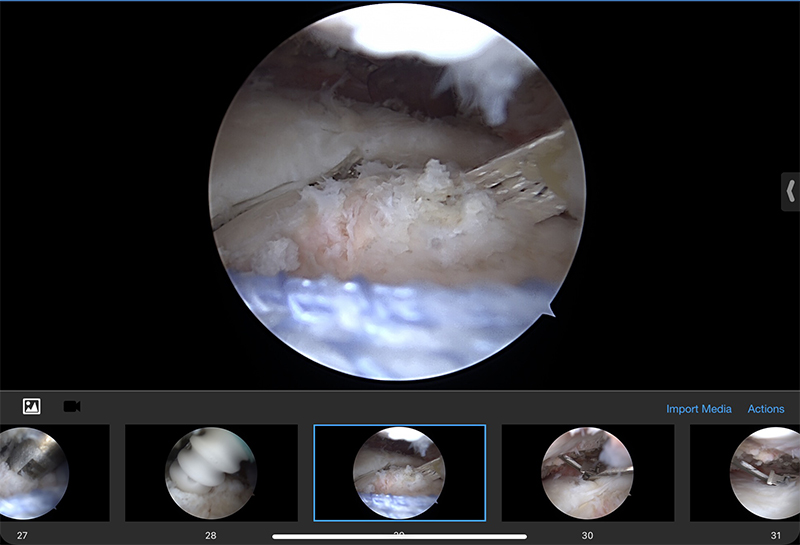 Rotator Cuff Repair