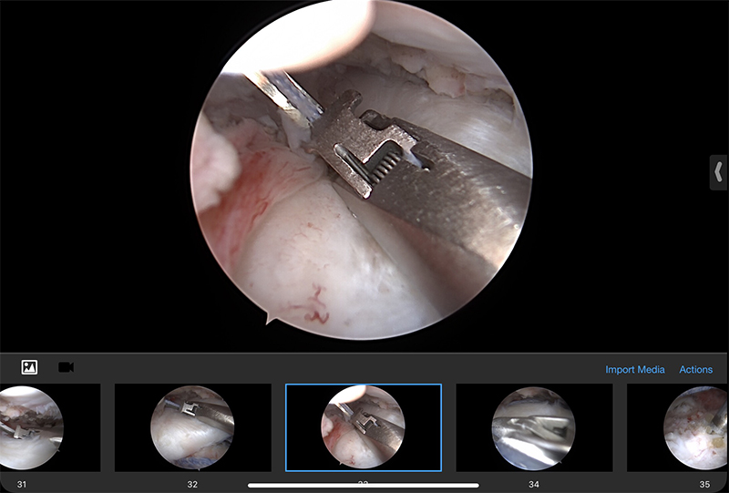 Rotator Cuff Repair