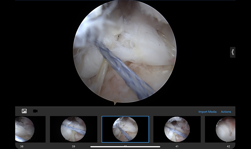 Rotator Cuff Repair