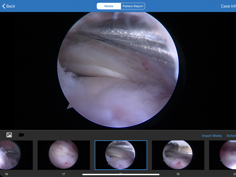 supraspinatus1