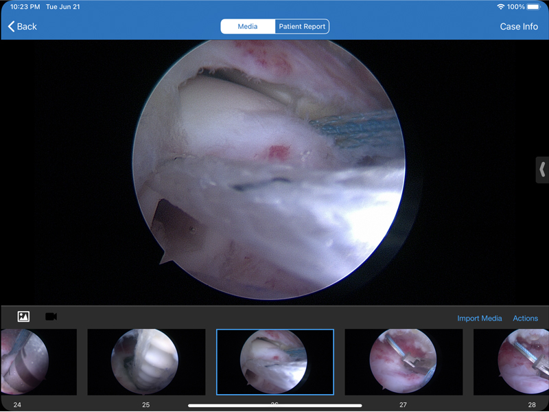 supraspinatus3