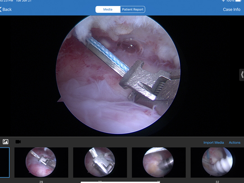 supraspinatus4