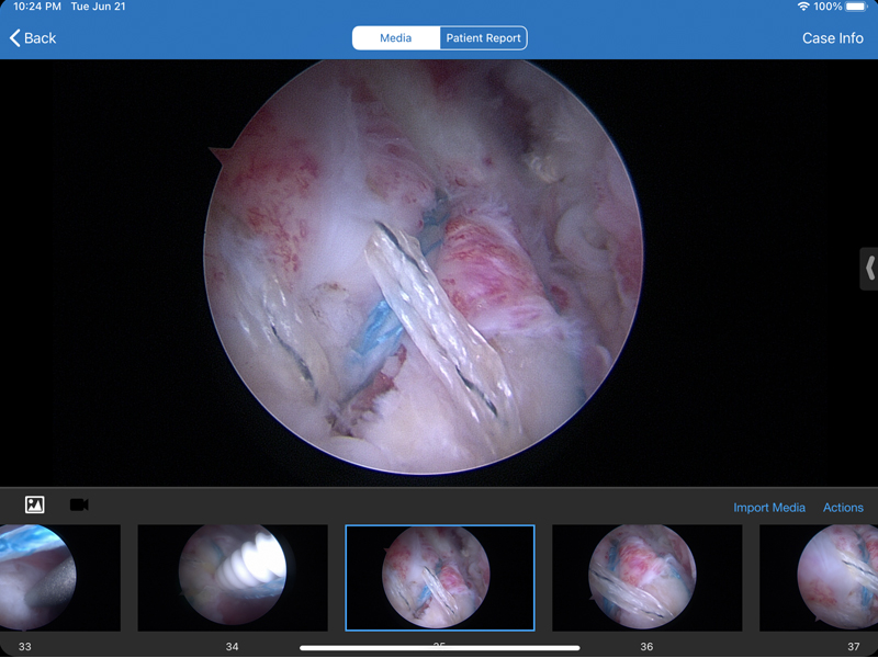 supraspinatus6