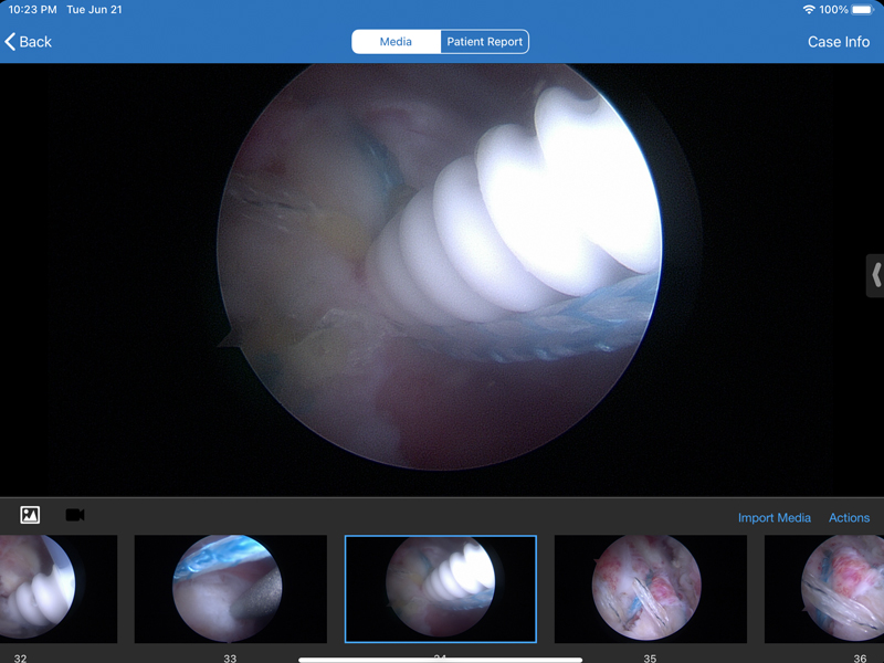 supraspinatus5