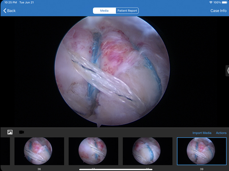 supraspinatus7