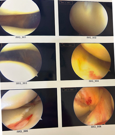 Arthroscopic tibial spine avulsion fracture fixation with concominant MCL repair/internal brace