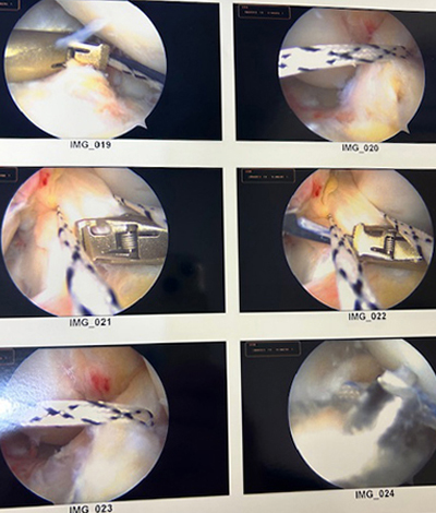 Arthroscopic tibial spine avulsion fracture fixation with concominant MCL repair/internal brace