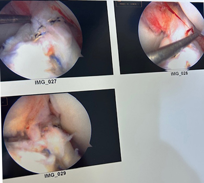 Arthroscopic tibial spine avulsion fracture fixation with concominant MCL repair/internal brace